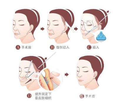 下筋膜懸吊祛皺術怎么操作的？*果嗎？