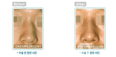 歪鼻矯正手術(shù)