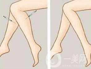 *瘦小腿一般多少錢？