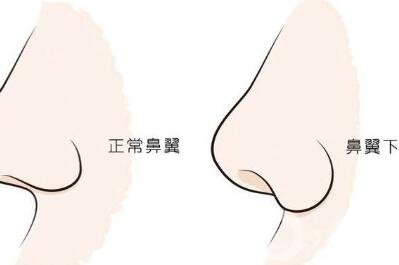 鼻翼缺損矯正*大嗎？要多少錢？