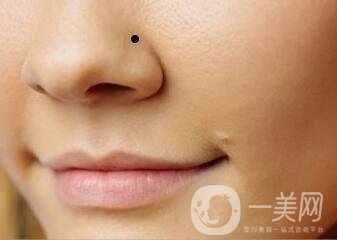 鼻翼缺損矯正*大嗎？要多少錢？