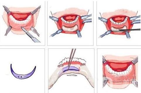 膨體隆下巴多久會變軟？容易取出來嗎？