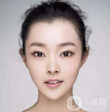 膨體隆下巴多久會變軟？容易取出來嗎？