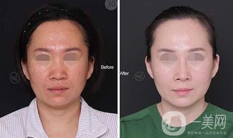 鼻頭縮小手術(shù)