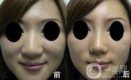 鼻頭縮小手術(shù)