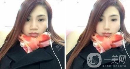 鼻頭縮小手術(shù)