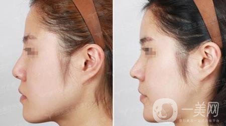 韓式肋軟骨隆鼻