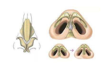 鼻頭肥大縮小術(shù)是持久*的嗎？