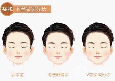 女人后縮下頜角整形變化有多大?