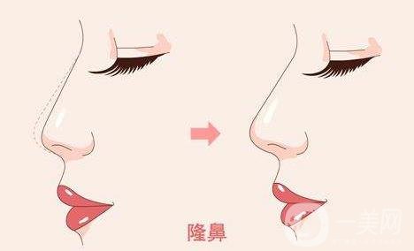 隆鼻手術(shù)會(huì)對(duì)我們的身體有危害嗎?