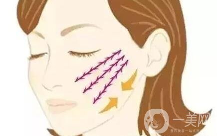 微創(chuàng)面部提升術(shù)