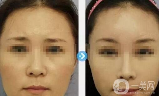 微創(chuàng)面部提升術(shù)
