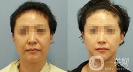 微創(chuàng)面部提升術(shù)