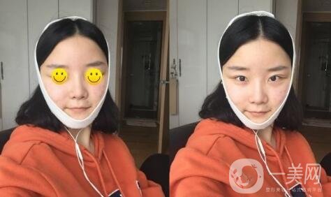 微創(chuàng)面部提升術(shù)