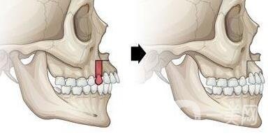 上頜后縮怎么矯正？手術(shù)有風(fēng)險嗎？