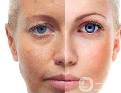 激光祛斑好嗎？需要打麻藥嗎？