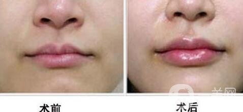 玻尿酸豐唇
