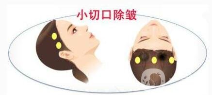 小切口除皺術(shù)后恢復(fù)過程是怎樣的？