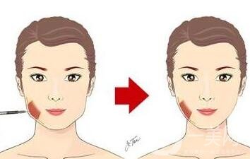 咬肌切除手術多少錢?有哪些影響因素?