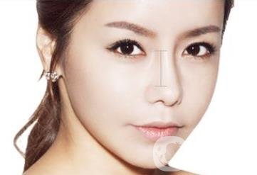 鷹鉤鼻矯正術后注意事項有哪些？