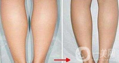 360度環(huán)形吸脂