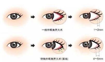 開外眼角會留疤嗎？留疤了怎么辦？