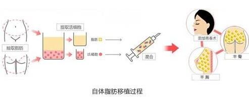 自體脂肪豐鼻唇溝*果怎么樣?能*保持嗎?