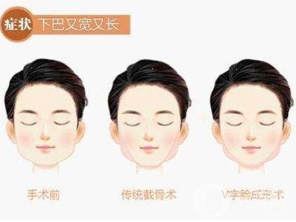 下頜角手術術后護理要注意哪些？