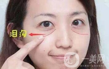 玻尿酸豐淚溝有危險嗎？能管多久？