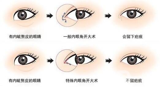 韓式開眼角手術(shù)*果怎么樣?看前后圖
