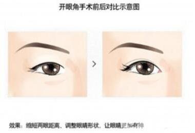 韓式開眼角手術(shù)*果怎么樣?看前后圖