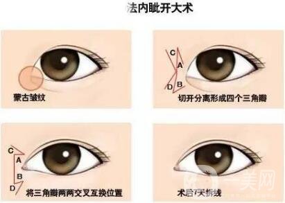 開內(nèi)眼角后遺癥