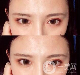 開內(nèi)眼角后遺癥