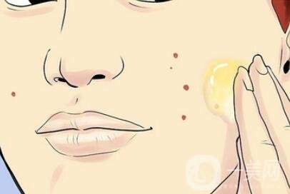 激光治痘疤要做幾次？多久見*？