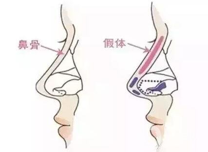 硅膠隆鼻假體取出術(shù)后護(hù)理注意事項(xiàng)有哪些呢?