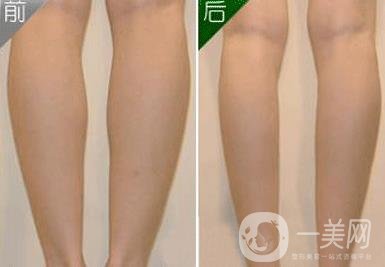 神經(jīng)瘦小腿