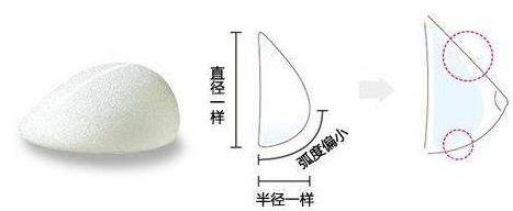 水滴型假體隆胸