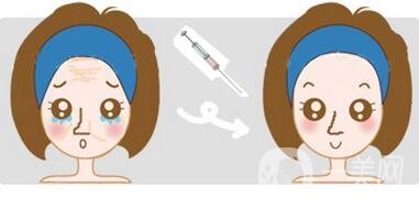 填充式注射除皺*果好嗎?可以保持多久?