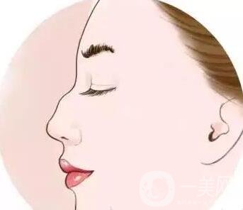 駝峰鼻矯正價(jià)錢(qián)貴嗎?大概是多少?