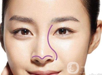 鼻尖成形術術后注意事項盤點