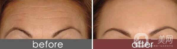 抬頭紋手術價格