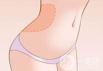 腹壁整形多少錢？費(fèi)用詳細(xì)解說