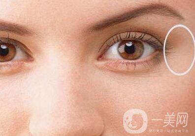 開(kāi)眼角好嗎？*果怎么樣？