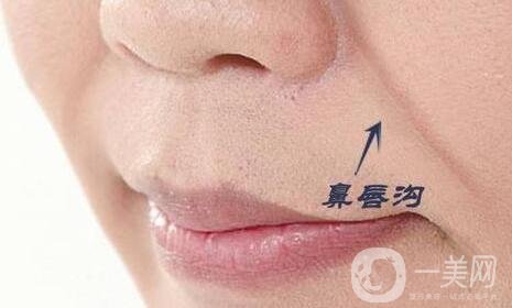 去鼻唇溝多少錢?哪種材料便宜些?