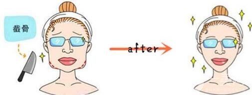 去頰脂墊后遺癥的常見情況有哪些?