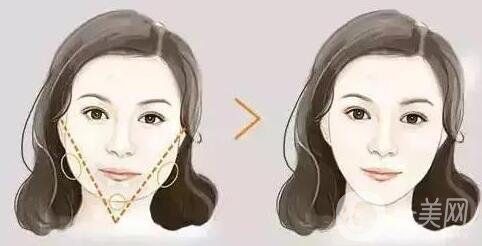 去頰脂墊后遺癥的常見情況有哪些?