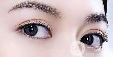 吸雕雙眼皮是*的嗎?缺點(diǎn)有哪些