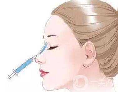 注射玻尿酸會腫嗎?