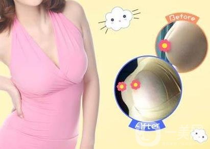 娜高豐胸假體好不好？需要多少錢？