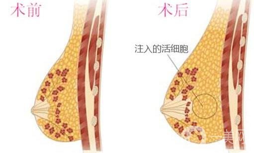 自體細(xì)胞豐胸*果自然嗎？要恢復(fù)多久？